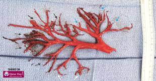 An embolism, which happens when a blood clot travels to the lungs, may cause a person to cough up blood. A Man Coughed Up This Perfectly Shaped Blood Clot Stunning His Doctors