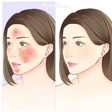 Bawah, jln pak sako 4, bandar sri semantan, temerloh, pahang. Best Acne Treatment In Kuantan Price Guide Reviews