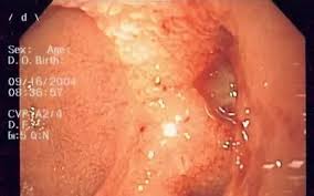 Image result for Colonoscopy in GI Bleeding