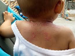 Image result for sweat rash on back baby