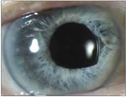 Pupilla) orphan child, ward, minor. Crsteurope Complications Of Small Pupil Cataract Surgery