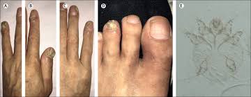 Skin usually heals within four weeks. Nail Infestation An Atypical Presentation Of Typical Scabies The Lancet