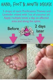 For Hfmd Essential Oils For Kids Essential Oils For Babies Essential Oils Health
