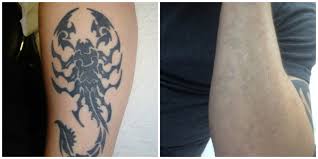 The laser light harmlessly passes through the skin, but it forces pigment particles to begin vibrating. Laser Tattoo Removal Richmond Mechanicsville Va