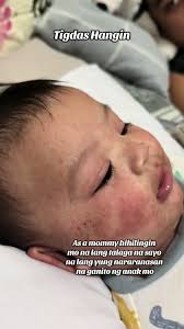 Pwede Ba Paliguan Ang May Tigdas Hangin