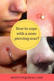 Bump Effective Fast Keloid Nose Piercing Rid Treatme How To Get Rid Of A Nose Piercing Bump Fast Keloid Piercing Bump Nose Piercing Nose Piercing Bump