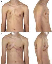 Patients with poland syndrome might go under plastic surgery in dallas to correct the chest wall deformity, improve the pectoral or breast contour, and recover confidence. Chest Wall Repair In Poland Syndrome Complex Single Stage Surgery Including Vertical Expandable Prosthetic Titanium Rib Stabilization A Case Report Journal Of Pediatric Surgery