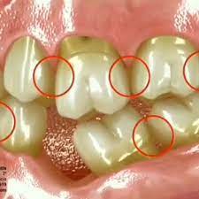 Teeth Overeruption Video Dental Posters Dental Anatomy Dental Videos