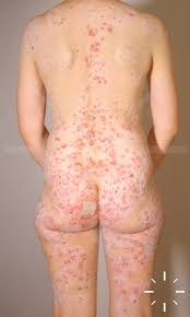 Image result for Pemphigoid