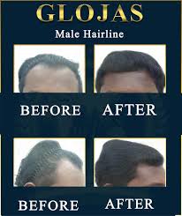 In 2019, mr mohd ali (dr.) was awarded global health award for smart™ aesthetic clinic of the year. Glojas Hair Transplant Center In Sri Hartamas Malaysia Read 782 Reviews