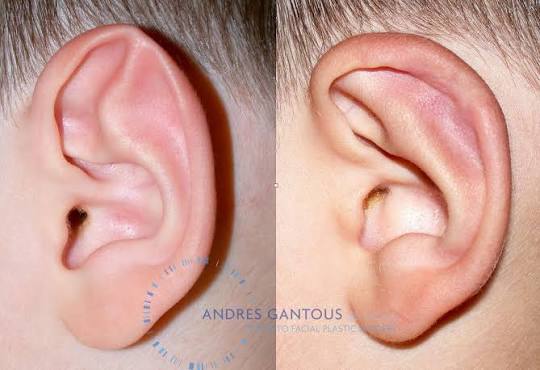 Correction of a Stahl's ear deformity. هل يجب علاج أذن الخفاش عند كل طفل
