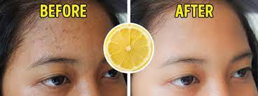 7 Foods That Reduce Acne Scars International News Agency