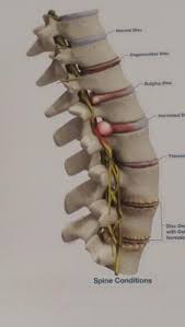 A spinal disc is jelly donut with softer center within a tougher exterior. Friend With Slip Disc Dilemna