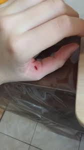 Ein oberflächlicher schnitt macht uns daher an den fingern nicht so viel aus wie etwa auf der wange. Sollte Das Genaht Werden 0 Medizin Finger Schnittwunde