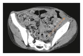 Image result for Neutropenic Colitis