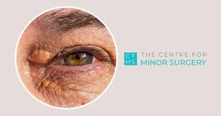 Image result for xanthelasma of eyelid