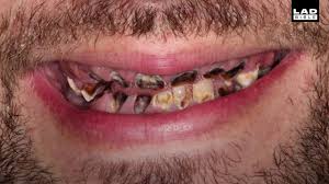 It can occur due to many factors and it is necessary to consult a dentist for preventing total tooth decay. Dentist Fixes Rotten Teeth For Free Youtube