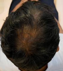 Undergoing hair loss treatment can be quite daunting and for many an experience which is confusing as there are so many treatments out there. Regenera Activa Eskulap Clinic