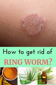 Hand sanitizer (also known as hand antiseptic, hand disinfectant, hand rub, or handrub) is a liquid, gel or foam generally used to kill the vast majority of viruses/bacteria/microorganisms on the hands. 126 Aaa Ringworm Ideas Ringworm Ringworm Remedies Remedies