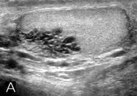 Tubular ectasia of the epididymis is defined as enlargement of the epididymis with multiple interfaces (i.e., a speckled appearance). Https Wjmh Org Pdf 10 5534 Kja 2012 30 1 90
