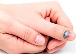 Imajte na umu da nedostatak vitamina d, b1, kalcija i željeza također može dovesti do promjena na noktima Podnogtevaya Hematoma Lijecenje Kompetentno O Zdravlju Na Ilive