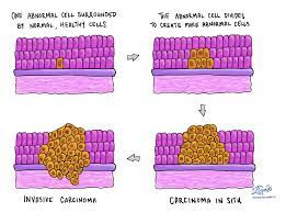 Basal cell carcinoma often appears as a slightly transparent bump on the skin, though it can take other forms. Carcinoma In Situ Cis Pathology Dictionary Mypathologyreport Ca