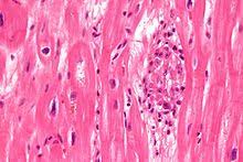 Visit the myocarditis foundation online to learn more. Pathologie Herz Wikibooks Sammlung Freier Lehr Sach Und Fachbucher