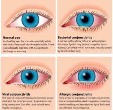 We did not find results for: Pink Eye Conjunctivitis Granthealth Org