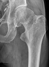 Imaging Findings Of Metabolic Bone Disease Radiographics