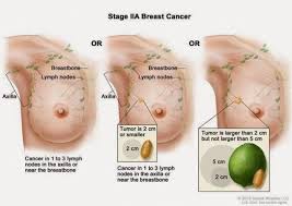 And breast, ovarian, and prostate tumors. Pin On Mesothelioma Cancer Treatment