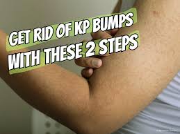 Image result for Keratosis pilaris