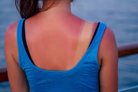Image result for Sunburn