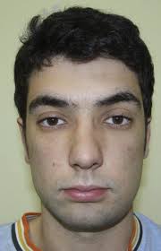 Mandibular Resection and Reconstruction in the Management of Extensive  Ameloblastoma