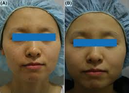 Low‐Fluence Q‐Switched 1,064‐nm Neodymium‐Doped Yttrium Aluminum Garnet  Laser for the Treatment of Facial Partial Unilateral Lentiginosis in  Koreans