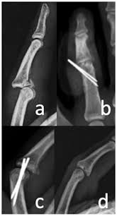 Image result for Volar PIP Dislocation