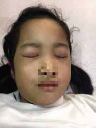 RASH AND WEAKNESS—A CASE OF JUVENILE DERMATOMYOSITIS ABSTRACT PATIENT'S  REVELATION: WHAT HAPPENED? Picture 1: Heliotrope ras