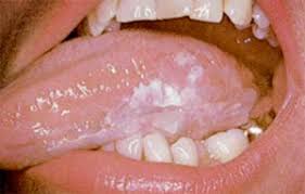 Image result for white cancer on tongue)