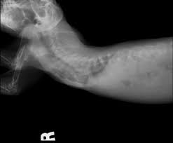 There is a period of at least 6 months before the sternum heals after the classic ravitch operation. Pectus Excavatum And Swimmer Puppy Syndrome With Concurrent Congenital Cardiac Anomalies In Two Domestic Rabbits Sciencedirect