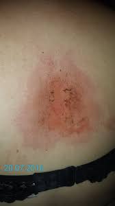 Check spelling or type a new query. Heftige Allergische Reaktion Allergie Hautarzt Lymphknoten