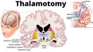Image result for Pallidotomy