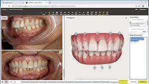 Aligner schienen können jederzeit herausgenommen werden. Zahnstellungskorrektur Mit Invisalign Auf Die Naturliche Schiene