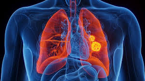 Image result for Lung Cancer