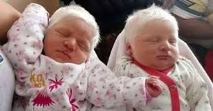 There are even those that have a normal hair color (brown, black) and light colored eyes. Mom Gives Birth To Rare Twin Girls Only For Their Hair To Make Them Viral