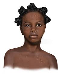 Young Black Girl with Skin Condition