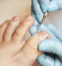 Image result for mykoza nehtů