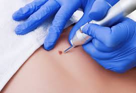 Image result for Cryotherapy