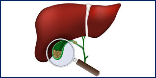 Image result for Choledocholithiasis