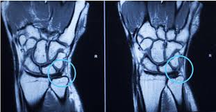 Image result for TFCC Steroid Injection