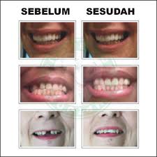 Jika gigi palsu lepasan bisa anda lepas dan pasang kapan saja tanpa perlu bantuan dokter, maka gigi palsu namun, biaya pasang gigi palsu lepasan cenderung mengalami penurunan di tahun 2021. Beli Promo Temptooth Gigi Palsu 400 Butir Buat Sendiri Perawatan Kecantikan Murah Seetracker Indonesia