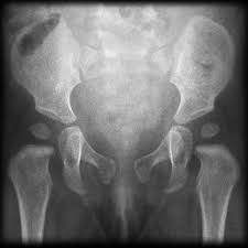 Pelvic X Ray Different Ages Radiology Case Radiopaedia Org